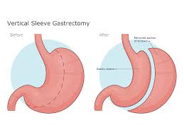 gastric sleeve surgery private