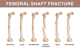 fem shaft fractures types causes