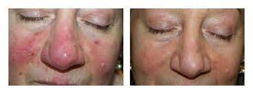 rosacea significant results with a