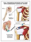 Image result for workers comp when to get a lawyer injured shoulder