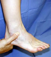 Ankle Sprain Stats   Info   The Ankle Roll Guard Prevents Ankle    