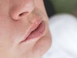 burn on lip how to treat various types