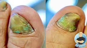 damaged toenails mississauga foot clinic
