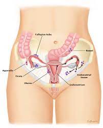 endometriosis symptoms treatment