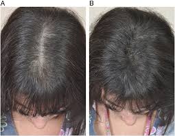 Among identical twins, if one is affected, the other has about a 50% chance of also being affected. A Androgenetic Alopecia Thinning Of The Crown And Frontal Scalp Download Scientific Diagram