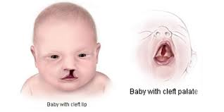 facts about cleft lip and cleft palate