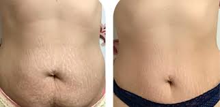 striort stretch marks treatment from
