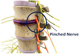 pinched nerve in neck or back causes