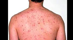 Learn the risks, symptoms and how to protect yourself when travelling or working in africa. First Case Of Rare Monkeypox Virus Reported In Singapore