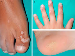 treatment of warts in children an