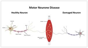 motor neuron disease viecell