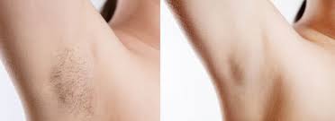 laser hair removal nyc hair removal