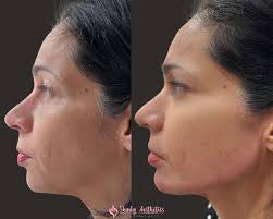 chin fillers benefits process and