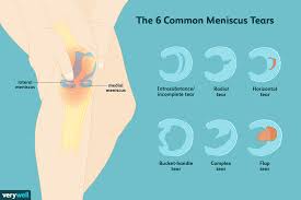 6 types of meniscus tears and treatments