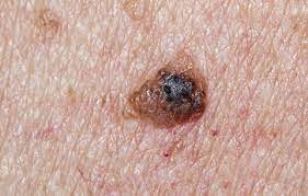 Basically what happens is, instead of growing upward and outward, an ingrown hair will curl back onto itself, creating a loop and becoming trapped below the skin's surface. 5 Signs Of Skin Cancer That Are Easy To Overlook Bicycling