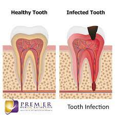 tooth infection abscessed tooth pain