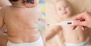 How to take your baby's temperature. Roseola How To Soothe Sixth Disease Symptoms Dr Axe