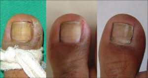 auckland ingrown toenail clinic