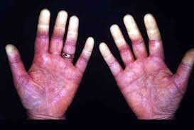 blanching of the skin causes and treatment