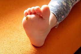 why does my child have plantar warts