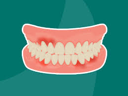 natural remes to treat receding gums