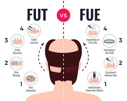 Maybe you would like to learn more about one of these? Hair Transplant Cost In Chandigarh Cost Of Hair Transplant In India