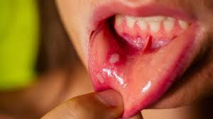 mouth ulcers 7 home remes to treat