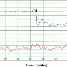 Fetal Heart Rate Monitoring Mode In Monica Dk V1 8 In A Case