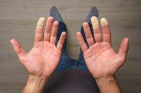 Raynaud's Syndrome – Symptoms and Treatment Options -