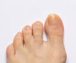 all you need to know about thick toenails