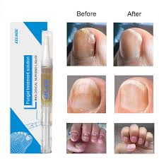 pro anti fungal nail treatment repair