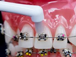 矯正中の歯みがきの方法｜デンタルフロス、歯間ブラシの使い方も紹介 | Lidea(リディア) by LION