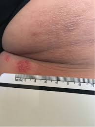 Diflucan one pill yeast infection. View Of Multiple Recurrences Of Hsv 1 On Right Lower Buttock The Southwest Respiratory And Critical Care Chronicles