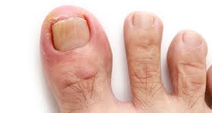 ingrown toenail how to treat cut