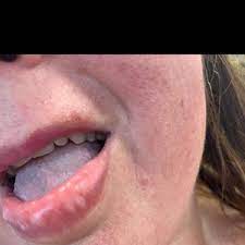 white spots on lip 2 weeks after filler