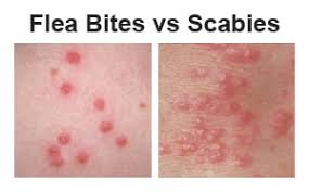 flea bites vs scabies how are they