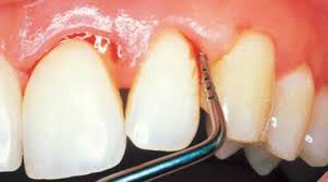 Điều trị viêm chân răng bằng phương pháp chuyên nghiệp
