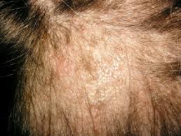 Lee ws, ro bi, hong sp et al (2007) a new classification of pattern hair loss that is universal for men and women: Tinea Capitis Dermnet Nz