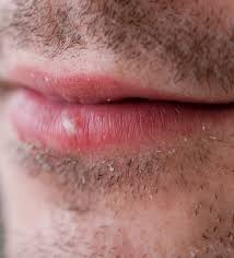 cold sore treatment solutions to