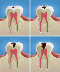 Tìm hiểu cách điều trị sâu răng tận gốc