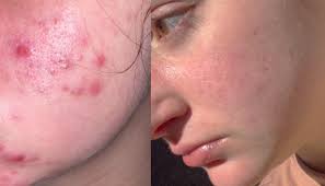 accutane before and after what i wish
