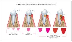 Gum Disease Treatment Pinehurst And Southern Pines Kuhn