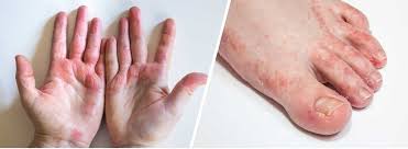 eczema atopic dermais center for