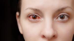 what causes pink eye and how do you