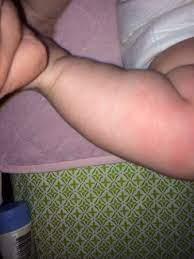 rug burn babycenter