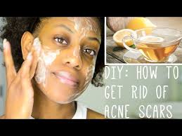 acne scars diy face mask