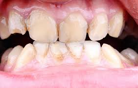 9 best treatments for gum disease
