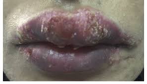 lips showing upper lip swelling