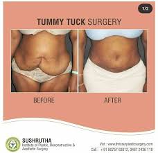 tummy tuck india abdominoplasty