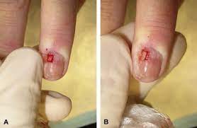 complete nail plate avulsion